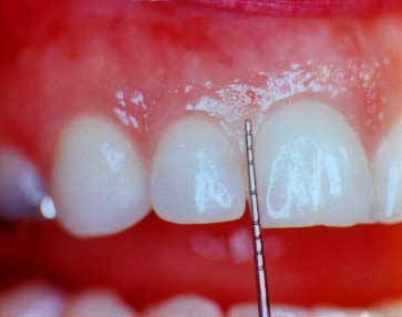 periodontal probe